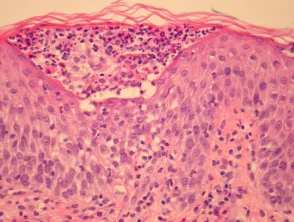 Patología de la pustulosis exantematosa generalizada aguda (AGEP) 