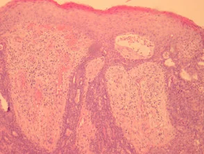 Aggressive Pathologie des digitalen papillären Adenokarzinoms