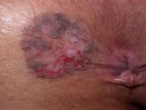Neoplasia intraepitelial anal.  AIN