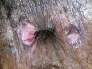 Carcinoma perinal de células escamosas in situ