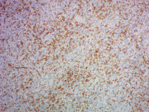 Patología del linfoma angioinmunoblástico de células T usando tinción PD1 x 100