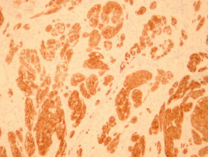 Nevus pigmentado de células fusiformes de la patología de Reed