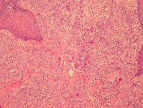 Nevus pigmentado de células fusiformes de la patología de Reed