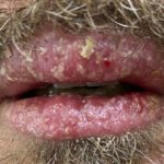 allergic-contact-cheilitis-propolis__protectwyjqcm90zwn0il0_focusfillwzi5ncwymjisingildfd-6010597-3867359-jpg-9216196