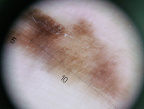 Dermatoscopia de melanoma lentiginoso acral