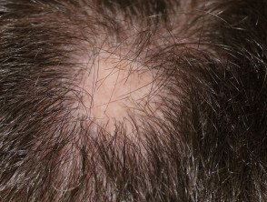 Alopecia areata en un paciente con antiTNF