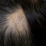 alopecia1__protectwyjqcm90zwn0il0_focusfillwzi5ncwymjisingildfd-3548637-6699266-jpg-2746816