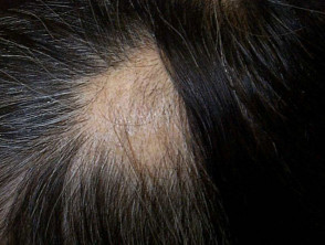alopecia1__protectwyjqcm90zwn0il0_focusfillwzi5ncwymjisingildfd-3548637-6699266-jpg-2746816
