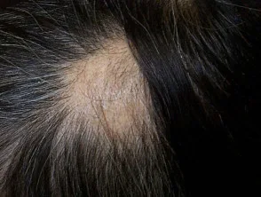 Alopecia areata