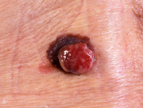 Melanoma amelanótico que surge con melanoma pigmentado