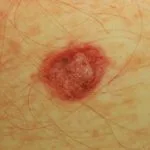 amelanotic-melanoma-021__protectwyjqcm90zwn0il0_focusfillwzi5ncwymjisingildfd-2168433-3985857-jpg-3994848