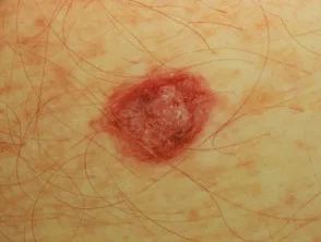 Melanoma amelanotico