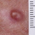 amelanotic-melanoma-034__protectwyjqcm90zwn0il0_focusfillwzi5ncwymjisingildfd-1168280-6781887-jpg-1293143