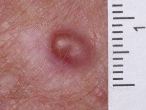 Macro de melanoma amelanótico