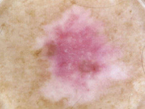 Dermatoscopia in situ de melanoma diseminado superficial amelanótico