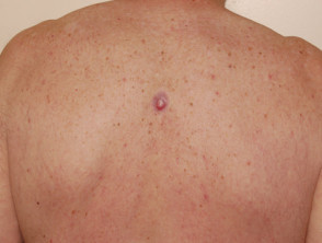 Melanoma amelanótico en la espalda