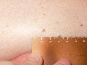 Macro de melanoma amelanótico