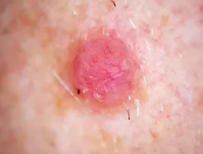 Dermoscopia del melanoma amelanotico