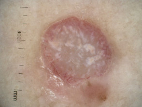 Dermatoscopia de melanoma amelanótico