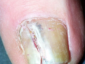 Unidad de melanoma de uñas