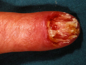 Melanoma de uñas amelanótico
