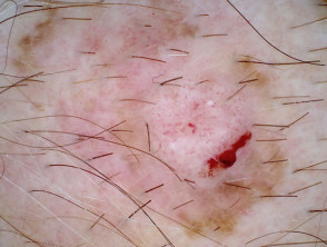 Dermatoscopia amelanótica de melanoma de extensión superficial