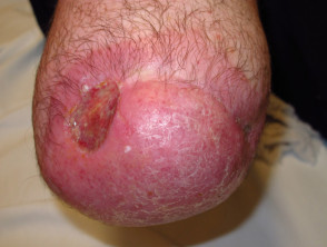 Dermatosis de muñón de amputación