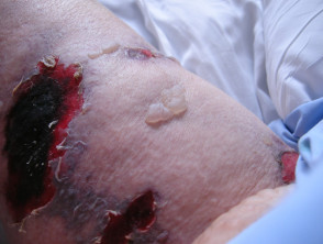 Problemas de la piel que afectan a un muñón amputado