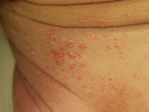 Problemas de la piel que afectan a un muñón amputado