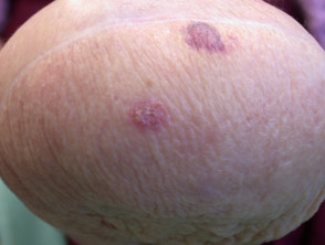 Cáncer de piel que surge en una extremidad de amputado