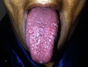 Macroglossia dovuta ad amiloidosi sistemica