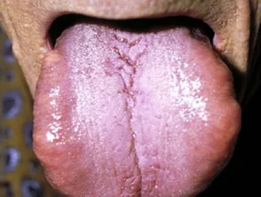 Macroglossia dovuta ad amiloidosi sistemica