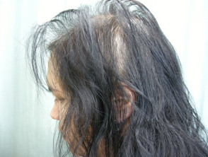 Efluvio anágeno: alopecia areata