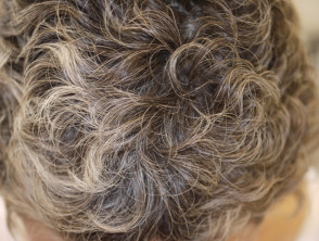 Efluvio anágeno: rebrote después de la quimioterapia con cabello rizado