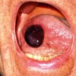 angina-bullosa__protectwyjqcm90zwn0il0_focusfillwzi5ncwymjisingildfd-5264647-4490479-jpg-9812426