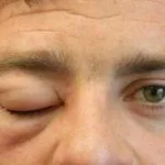 angioedema-001__protectwyjqcm90zwn0il0_focusfillwzi5ncwymjisingildfd-8465129-9838705-jpg-3391626