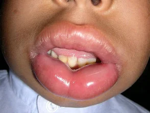 Angioedema