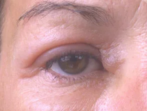 Angioedema