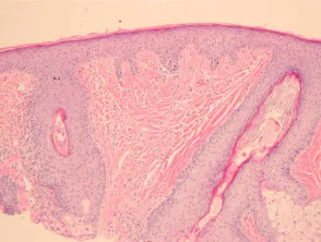 Angiofibrom-Pathologie