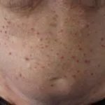 angioimmunoblastic-t-cell-lymphoma-07__protectwyjqcm90zwn0il0_focusfillwzi5ncwymjisinkildexxq-6457297-1198833-jpg-3796488