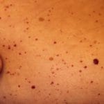 angiokeratoma-10__protectwyjqcm90zwn0il0_focusfillwzi5ncwymjisingildfd-3867557-4047466-jpg-5437223