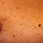 angiokeratoma-10__protectwyjqcm90zwn0il0_focusfillwzi5ncwymjisingildfd-3867557-4047466-jpg-5437223