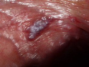 Angioqueratoma de Fordyce en vulva