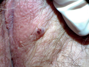 Angioqueratoma de Fordyce en vulva