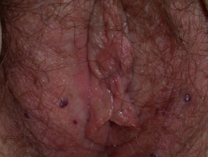 Angioqueratoma de Fordyce en vulva