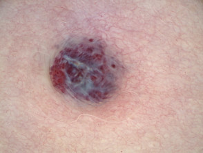 Dermatoscopia de angioqueratoma de Fordyce en vulva