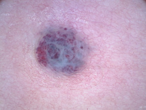 Dermatoscopia de angioqueratoma de Fordyce en vulva