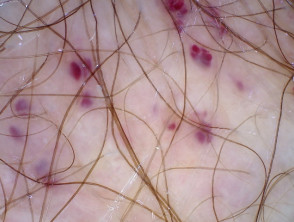 Dermatoscopia de angioqueratoma de Fordyce en vulva