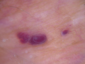 Dermatoscopia de angioqueratoma de Fordyce en vulva