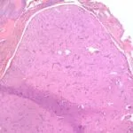angioleiomyoma-figure1__protectwyjqcm90zwn0il0_focusfillwzi5ncwymjisingildnd-3292086-7739442-jpg-8458143